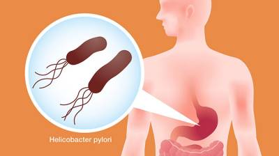 Detectar el Helicobacter Pylori para aliviar la úlcera de estómago